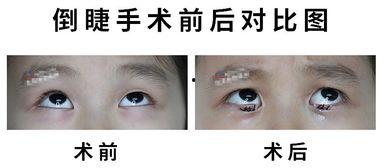 翻眼皮图片,瞬间提升眼部魅力